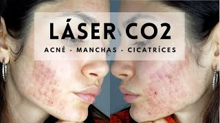 ACNÉ LASER CO2 Manchas y Cicatrices  Niki Mayo [upl. by Kurtz]