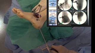 Ankle Surgery Subtalar Arthrodesis [upl. by Platto]