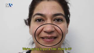 ¡IMPRESIONANTE El efecto inmediato de rellenos faciales  Dr Baja [upl. by Zimmer]