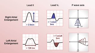 Intro to EKG Interpretation  Chamber Enlargement [upl. by Maier]