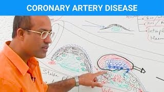 Coronary Artery Disease  Ischemic Heart Disease  Angina🫀 [upl. by Oirasan703]