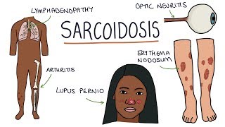 Lung Cancer  Bronchogenic Carcinoma  The most COMPREHENSIVE Explanation [upl. by Fabiano61]